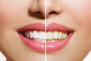 Teeth whitening