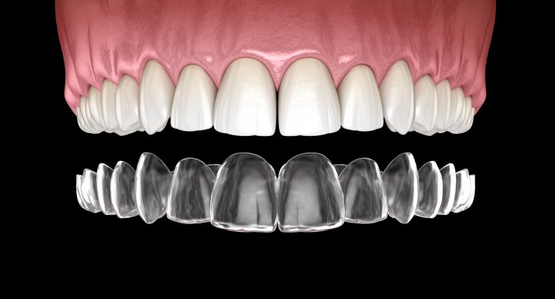 Invisalign Vs Spark Aligners What s The Difference Invisalign Vs Spark Aligners What s The Difference